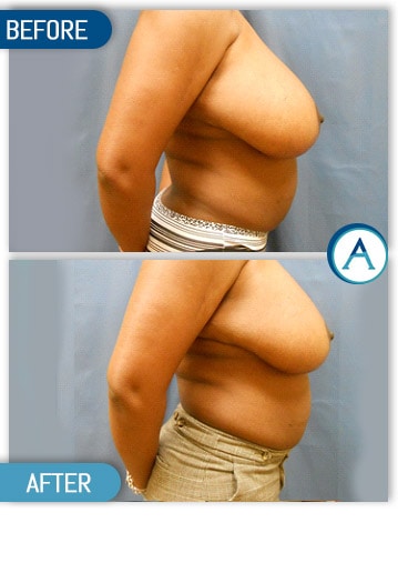 Breast Reduction Procedure Specialist Near Me in New Bern, NC