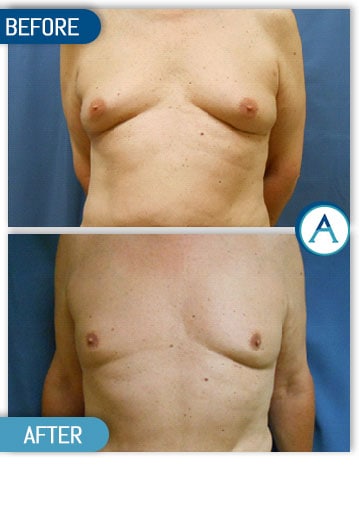 Easta Medical on X: Breast reduction surgery More