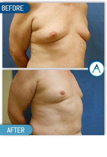 Easta Medical on X: Breast reduction surgery More