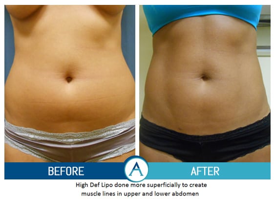 Liposuction Abdomen Treatment Before & After Gallery in New Bern, NC