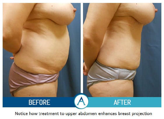 Liposuction Abdomen Treatment Before & After Gallery in New Bern, NC