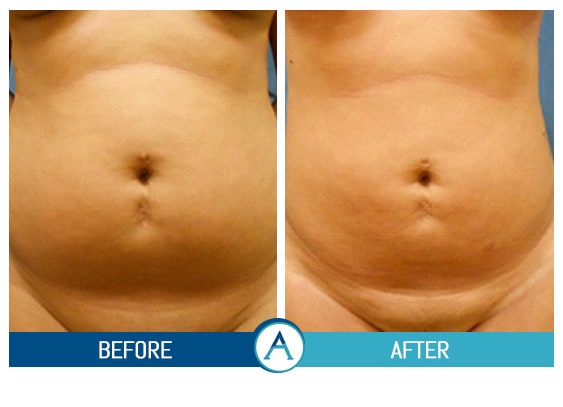 Liposuction Abdomen Treatment Before & After Gallery in New Bern, NC