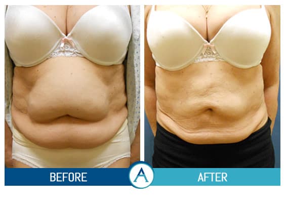 Liposuction Abdomen Treatment Before & After Gallery in New Bern, NC