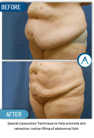 Liposuction Abdomen Treatment Before & After Gallery in New Bern, NC