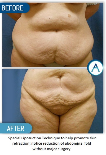 Liposuction Back and Flanks Treatment Gallery in New Bern, NC