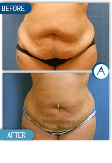 Liposuction Abdomen Treatment Before & After Gallery in New Bern, NC