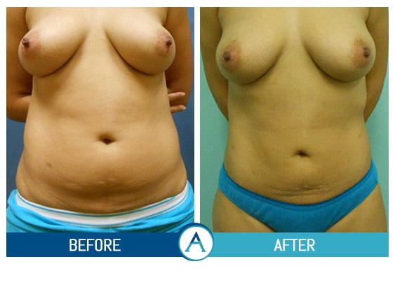 Liposuction Abdomen Treatment Before & After Gallery in New Bern, NC