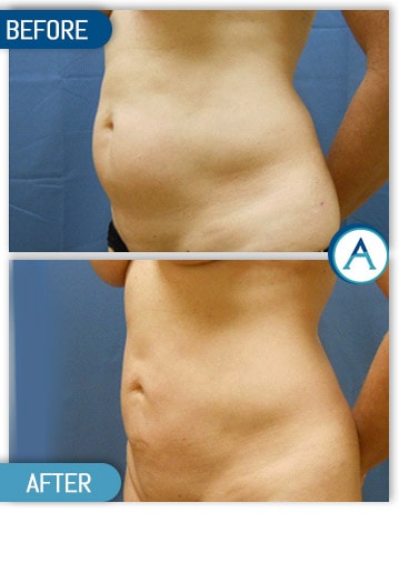 Liposuction Back and Flanks Treatment Gallery in New Bern, NC