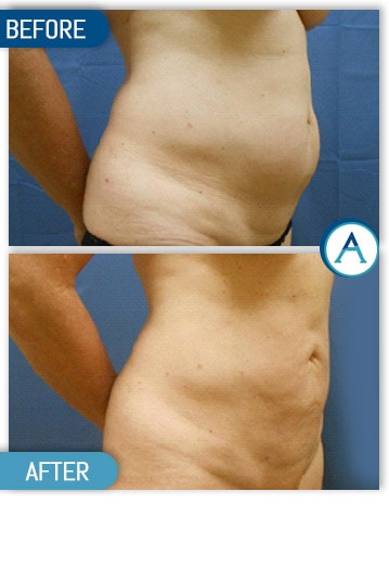 Liposuction Back and Flanks Treatment Gallery in New Bern, NC