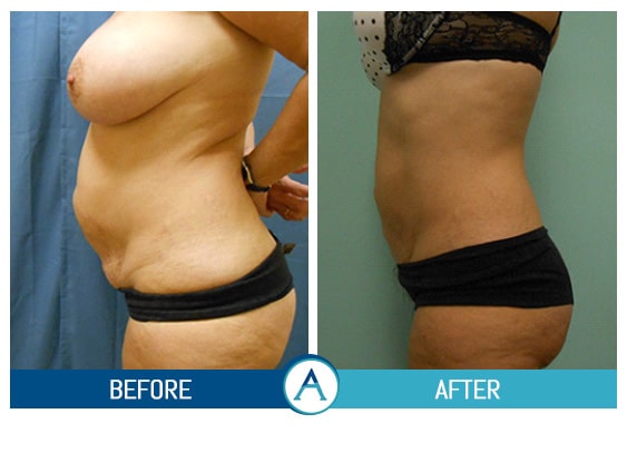 Liposuction Abdomen Treatment Before & After Gallery in New Bern, NC