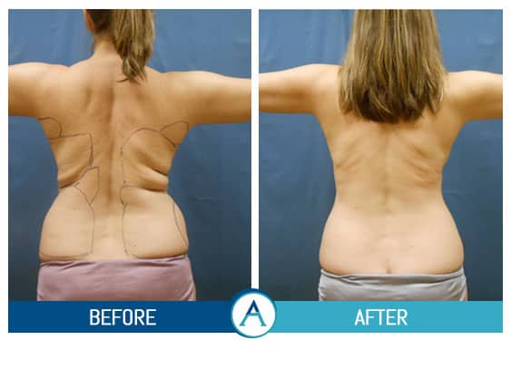 Smartlipo Flanks Liposuction for Women - Before & After Photos