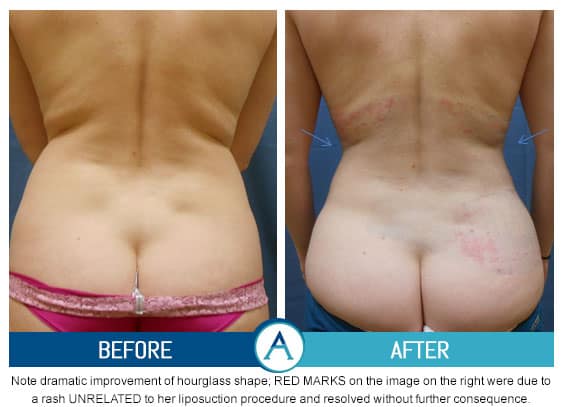 Liposuction Back and Flanks Treatment Gallery in New Bern, NC