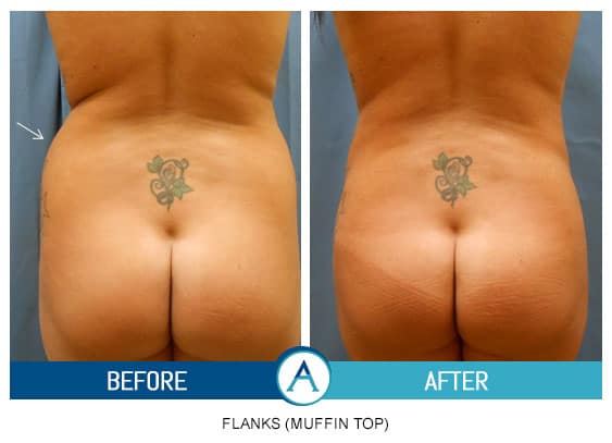 Liposuction Back and Flanks Treatment Gallery in New Bern, NC