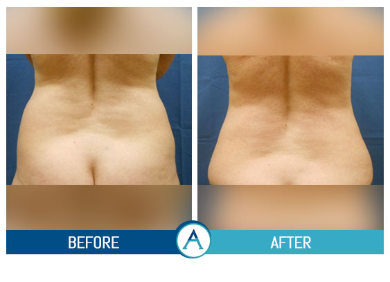 Liposuction Back and Flanks Treatment Gallery in New Bern, NC