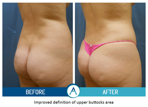 Liposuction Back and Flanks Treatment Gallery in New Bern, NC