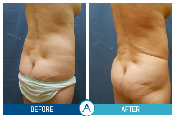 Liposuction Back and Flanks Treatment Gallery in New Bern, NC