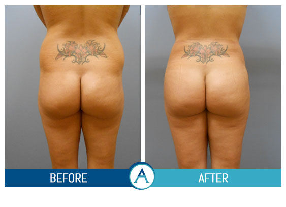 Liposuction Back and Flanks Treatment Gallery in New Bern, NC