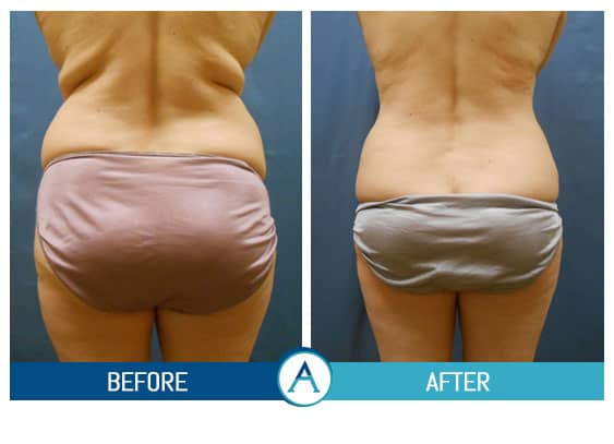 Liposuction Back and Flanks Treatment Gallery in New Bern, NC