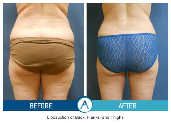 Liposuction of Flanks Before and After 3804