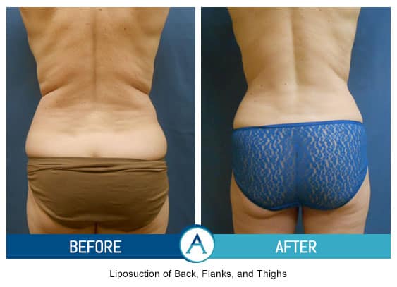 Liposuction Back and Flanks Treatment Gallery in New Bern, NC