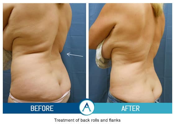 Liposuction Back and Flanks Treatment Gallery in New Bern, NC