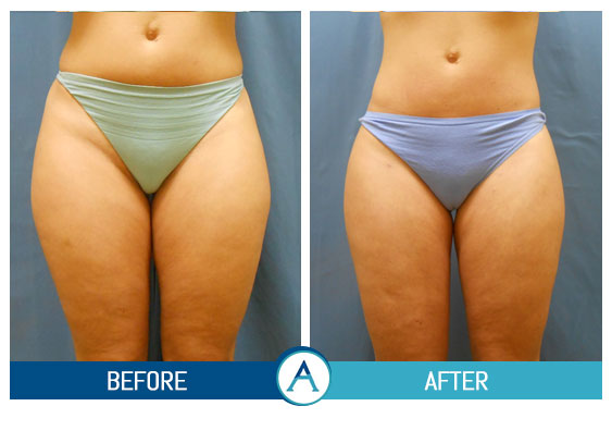 Liposuction Legs and Thigh Treatment Gallery in New Bern, NC