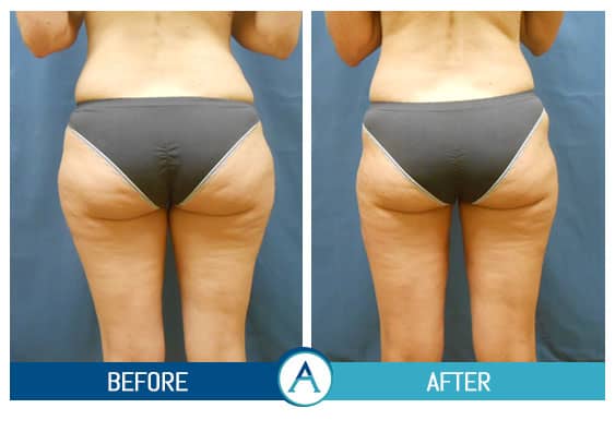 Thigh Liposuction. Your Best Option For Great Legs - Moawad Skin Institute  (MSI)