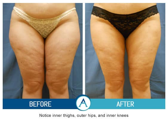 Inner Thigh Liposuction, Bakersfield & Orange County