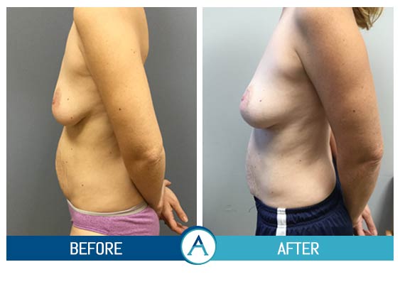 Breast Lift Before and After Photos