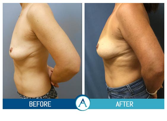 Scarless Breast Lift Before & After in New Bern, NC