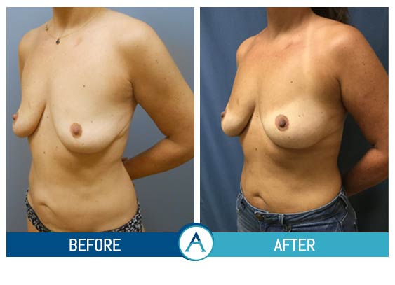 Scarless Breast Lift Before & After in New Bern, NC