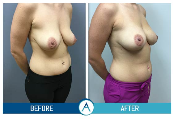 Scarless Breast Reduction - Is Breast Liposuction Effective