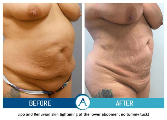 Liposuction Abdomen Treatment Before & After Gallery in New Bern, NC