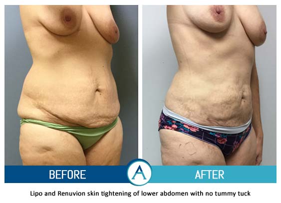 Liposuction Back and Flanks Treatment Gallery in New Bern, NC